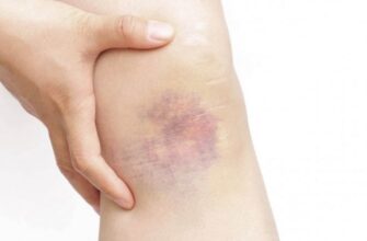 Ефективні методи лікування гематоми в домашніх умовах: поради та засоби