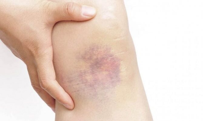 Ефективні методи лікування гематоми в домашніх умовах: поради та засоби