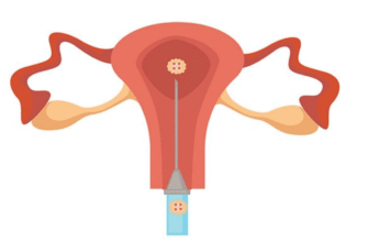 9-й день після переносу ембріонів: симптоми та ознаки успіху процедури