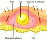Абсцес після уколу: причини, симптоми та методи лікування