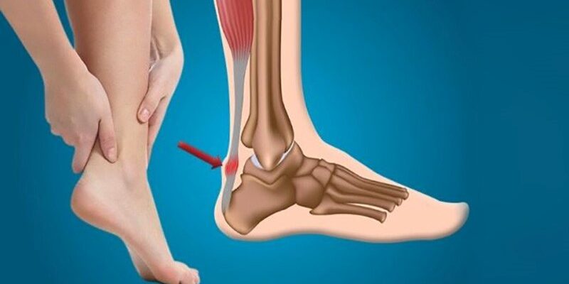 Ахіллове сухожилля: причини болю та ефективні методи лікування