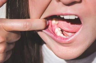 Антибіотики після видалення зуба: коли і чому вони необхідні?