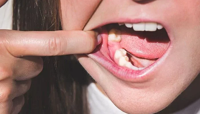 Антибіотики після видалення зуба: коли і чому вони необхідні?