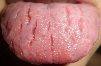 Біль під язиком: причини, симптоми та ефективні методи лікування