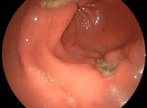 Біль під лівим ребром: причини і лікування болю, що віддає в спину