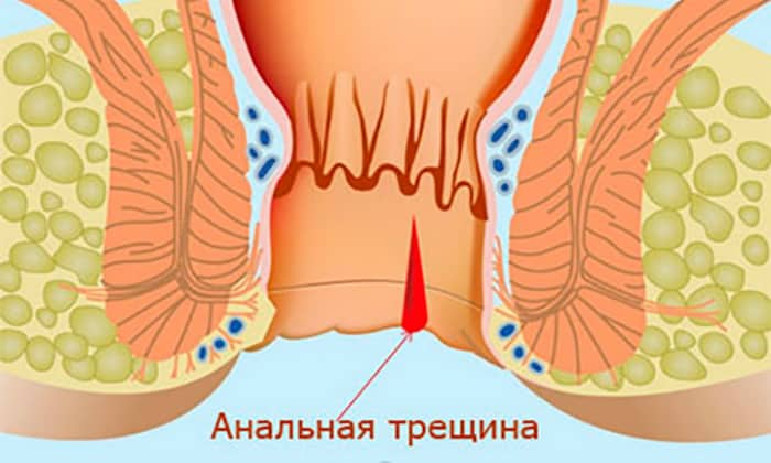 Після легування латексними кільцями