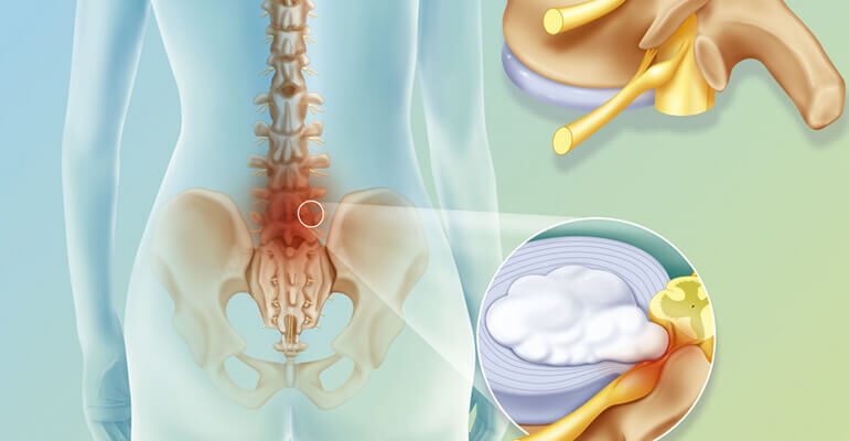 Біль у крижовому відділі: причини, симптоми та методи лікування