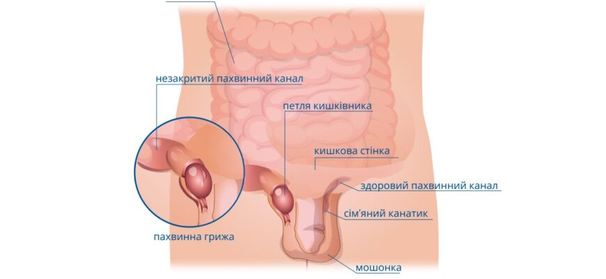 Біль у паху у чоловіків: причини, симптоми та методи лікування