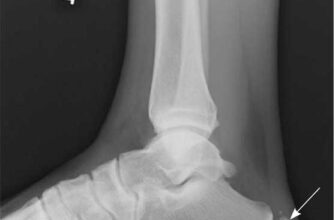 Біль у п’яти ззаду: причини, симптоми та ефективні методи лікування