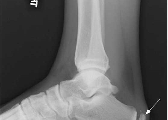 Біль у п’яти ззаду: причини, симптоми та ефективні методи лікування