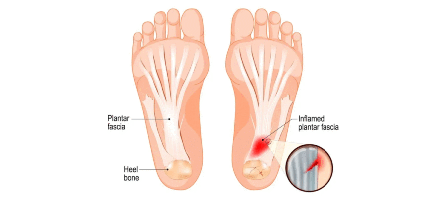 Біль у стопі з боку: причини, симптоми та методи лікування