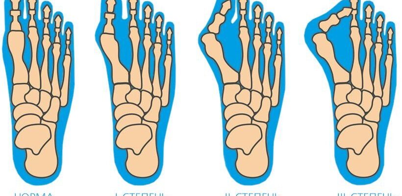 Біль у стопі збоку: причини, діагностика та ефективні способи лікування