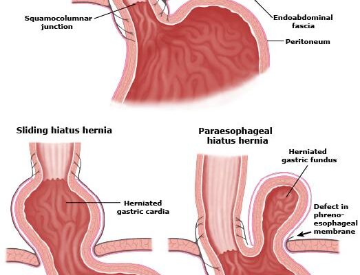 Біль у стравоході при ковтанні: причини, симптоми та лікування
