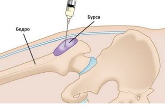 Біль у тазостегновому суглобі: причини, симптоми та лікування