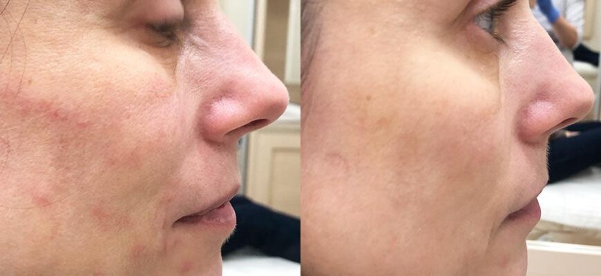 Біоревіталізація: Скільки процедур потрібно для оптимального ефекту?