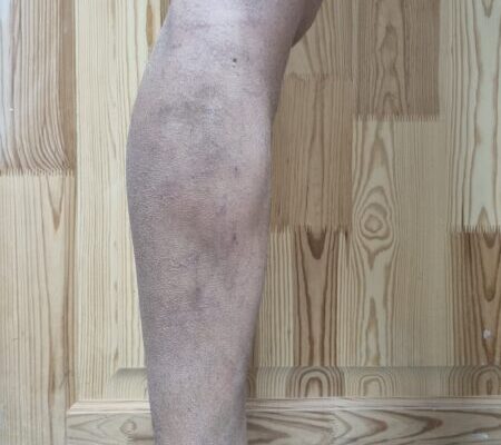 Блукаючий біль у нозі: причини, діагностика та методи лікування