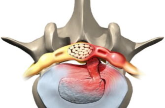 Болі після видалення грижі хребта: причини та способи полегшення