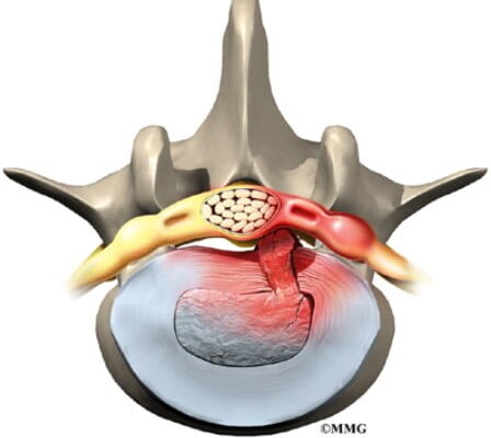 Болі після видалення грижі хребта: причини та способи полегшення