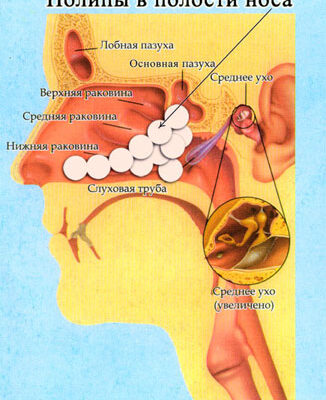 Болі після видалення поліпа: причини, симптоми та способи полегшення