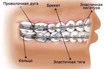 Брекети до і після: як змінюється обличчя та усмішка