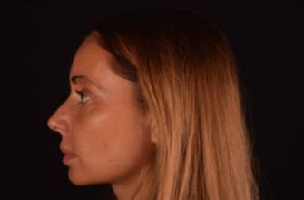 Булхорн до і після: зміни, переваги і результати після процедури