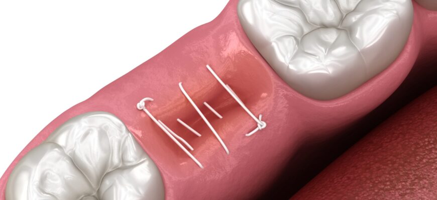 Через скільки часу розсмоктуються шви після видалення зуба: ключові факти