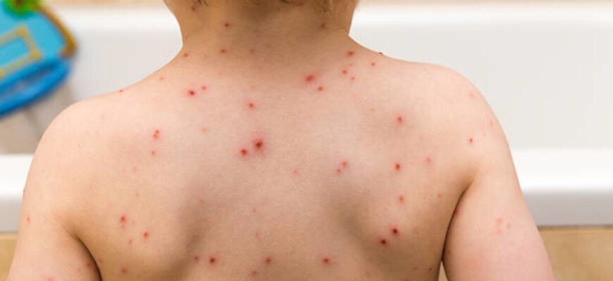 Через скільки днів після зараження з’являються симптоми вітрянки?