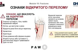 Чому набрякає рука після перелому: основні причини та способи лікування
