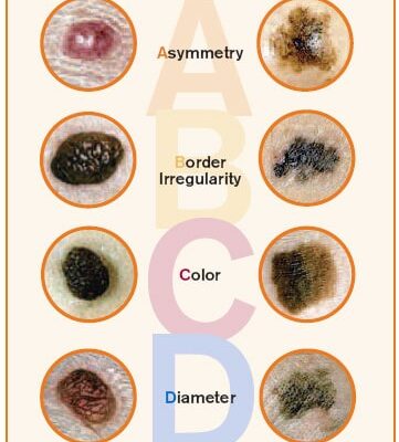 Чому не заживає рана після видалення родимки: основні причини й поради