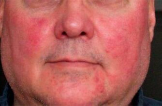 Чому виникає діарея після вживання алкоголю: причини та рішення