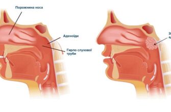 Чому виникають соплі після видалення аденоїдів та як з ними боротися?