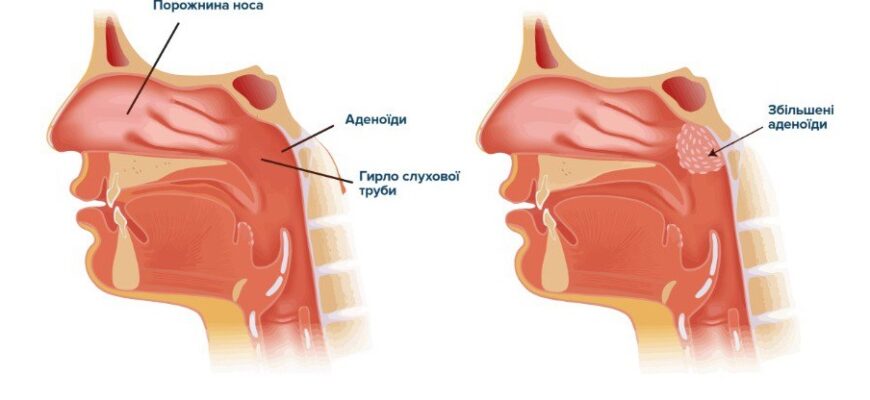 Чому виникають соплі після видалення аденоїдів та як з ними боротися?