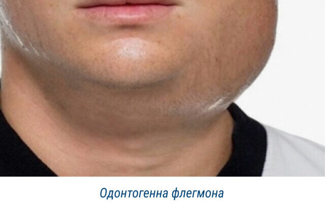 Чому з’являється біль у зубі після видалення нерва: основні причини