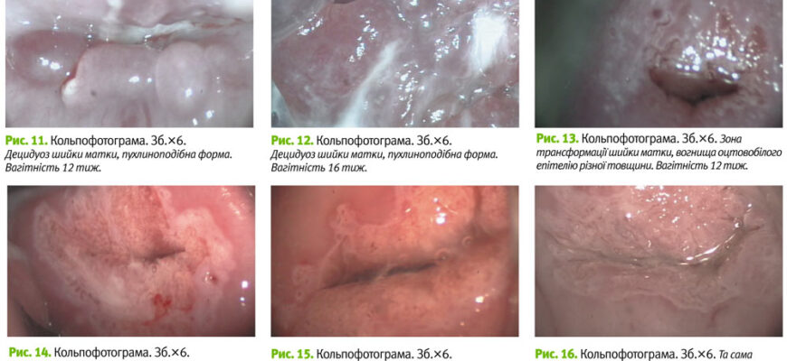 Чи можлива вагітність після припікання ерозії шийки матки: що варто знати?