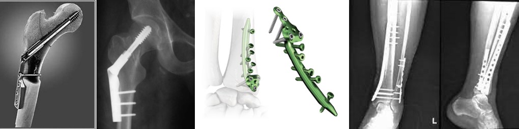 Остеосинтез, металоостеосинтез у лікуванні переломів кісток