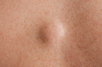 Чи потрібно видаляти жировик: поради лікарів та ризики втручання