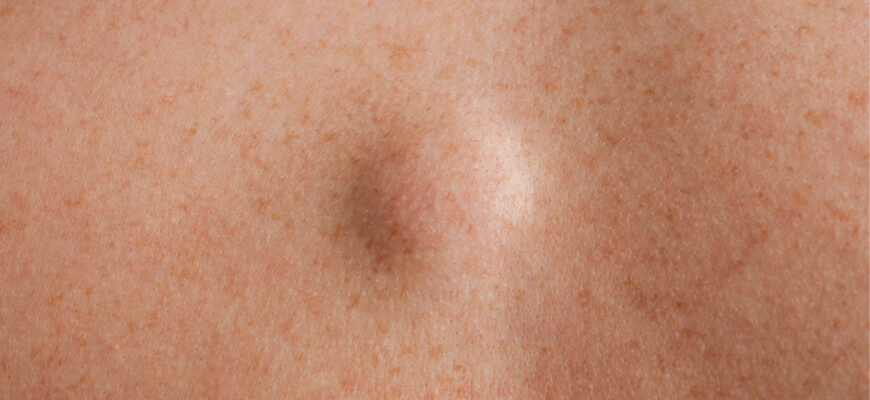 Чи потрібно видаляти жировик: поради лікарів та ризики втручання