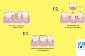 Чи треба видаляти нерв із зуба перед встановленням коронки: повний гід