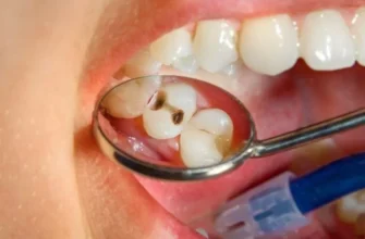 Чи варто лікувати карієс молочних зубів: важливі аспекти здоров’я дітей