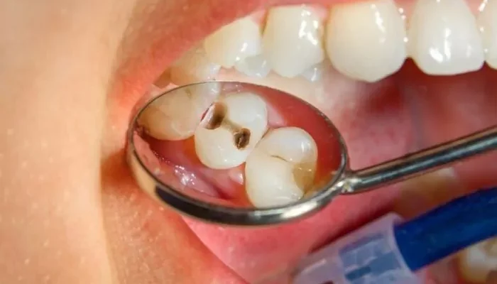 Чи варто лікувати карієс молочних зубів: важливі аспекти здоров’я дітей