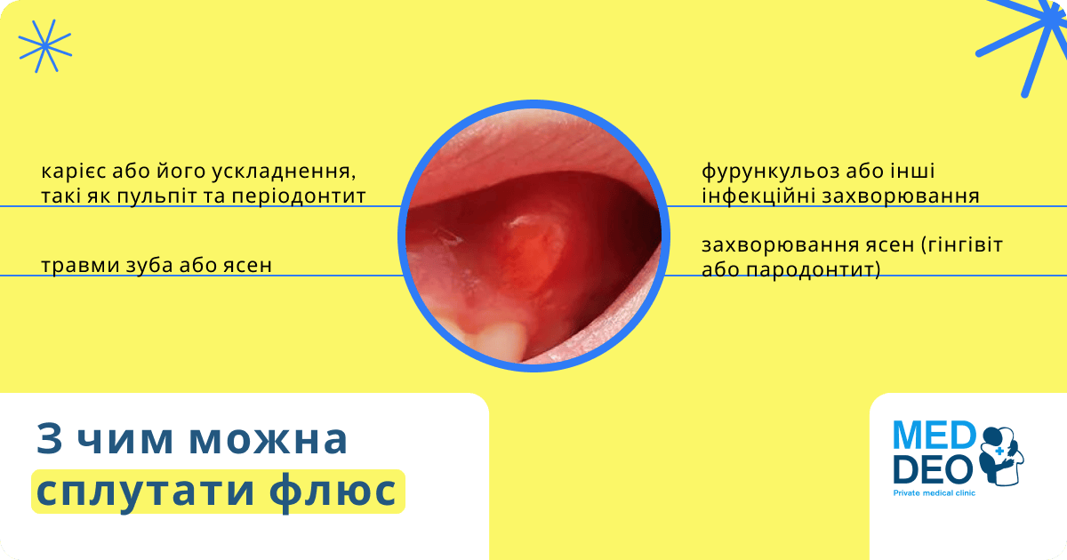 Флюс на десні ☘️ Чим полоскати зуби, щоб вийшов гній