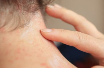 Чим мазати алергічний висип: ефективні засоби та рекомендації лікарів