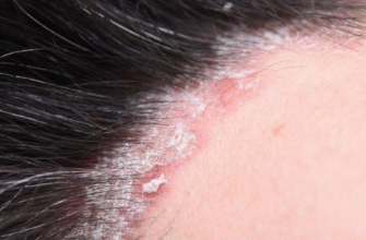 Чим найкраще мити голову при себорейному дерматиті: поради та засоби