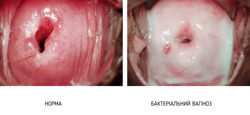 Чим небезпечний бактеріальний вагіноз під час вагітності: ризики та наслідки