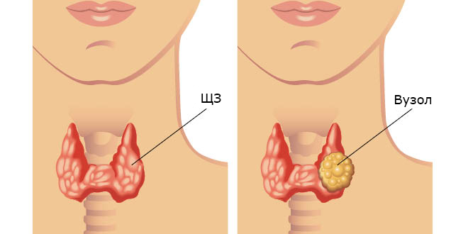 Чим небезпечний вузловий зоб: основні ризики та наслідки для здоров’я Чим небезпечний вузловий зоб: основні ризики та наслідки для здоров’я