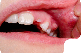 Чим полоскати флюс: ефективні засоби та поради для зняття симптомів