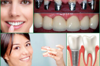 Чим полоскати рот для швидкого загоєння після імплантації зубів