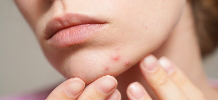 Чим зняти набряк: найефективніші способи та засоби для швидкого полегшення