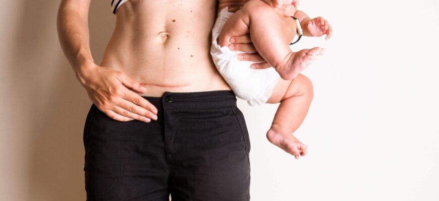 Діастаз після пологів: як виглядає та що робити з проблемою?