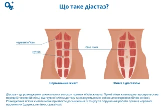 Діастаз після пологів: причини, симптоми і як відновити м’язи
